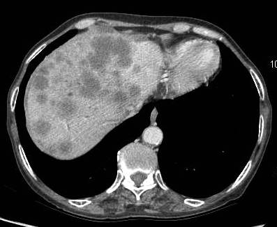 Figure 6: Advance carcinoma showing the entire liver parenchyma studded with secondaries